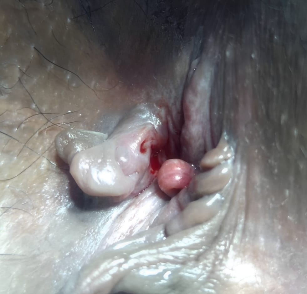 Hemorrhoids Image